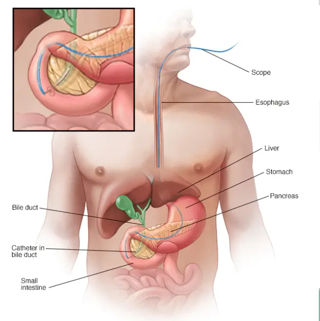 Gallbladder Disease And Gallstones